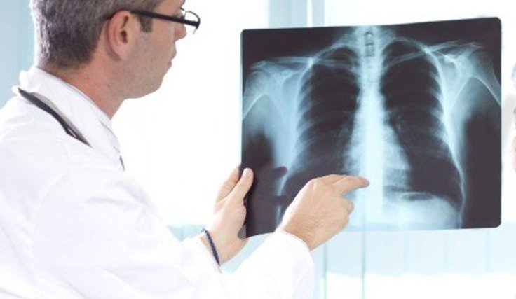 cancro do pulmão